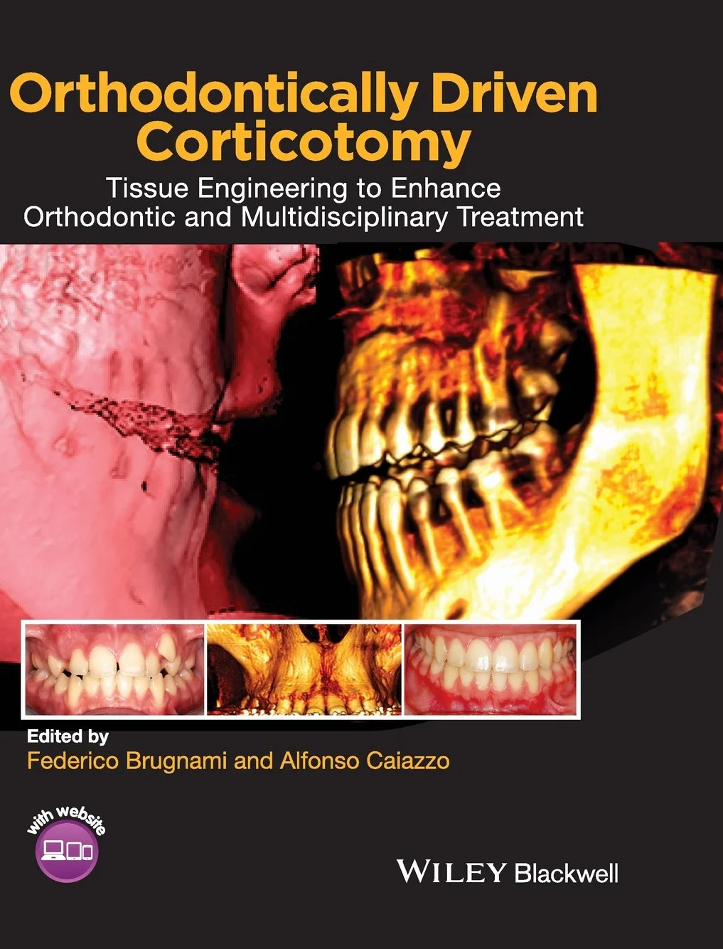 Orthodontically Driven Corticotomy: Tissue Engineering to Enhance Orthodontic and Multidisciplinary Treatment